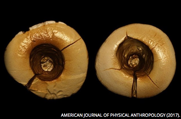 Foto de empastes dentales paleolíticos